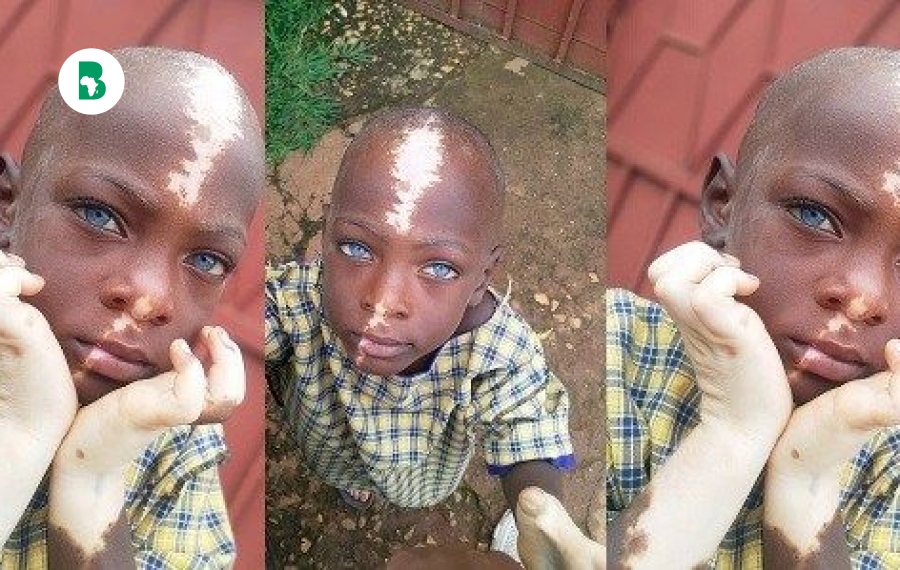 Un garçon ougandais fait le buzz sur Internet grâce à ses marques de naissance uniques